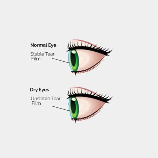 dry eye diagram