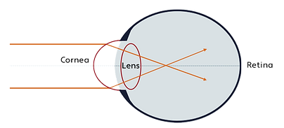 refractive-myopia